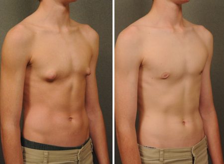 Male chest reduction Ludhiana